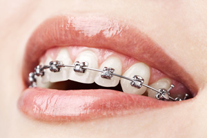 metal-braces